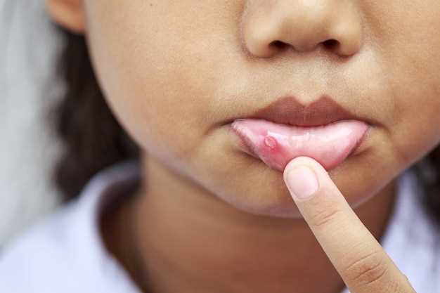 Как облегчить симптомы герпеса на половых губах?