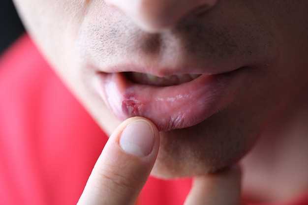 Как правильно диагностировать грибок на половых губах