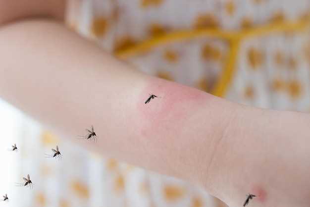Характеристики укуса комара